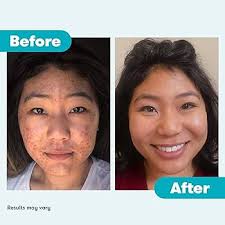 PanOxyl Acne Foaming Wash Benzoyl Peroxide 10% Maximum Strength